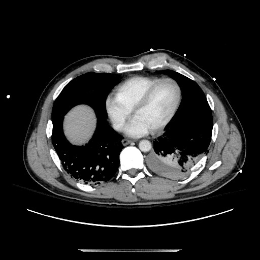 Blunt abdominal trauma with solid organ and musculoskelatal injury with active extravasation (Radiopaedia 68364-77895 A 3).jpg