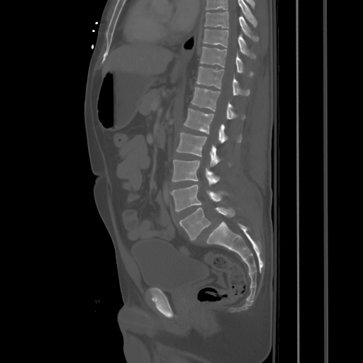 Blunt abdominal trauma with solid organ and musculoskelatal injury with active extravasation (Radiopaedia 68364-77895 Sagittal bone window 51).jpg