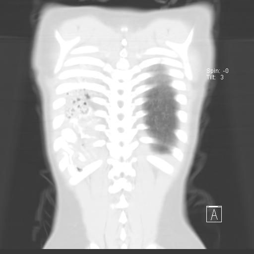 File:Bochdalek diaphragmatic hernia (Radiopaedia 38866-41059 Coronal lung window 19).jpg