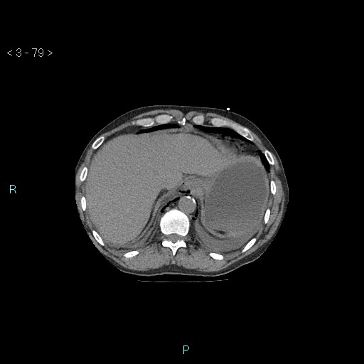 Boerhaave syndrome (Radiopaedia 27683-27897 Axial non-contrast 79).jpg