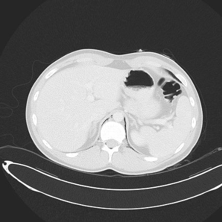 File:Boerhaave syndrome with mediastinal, axillary, neck and epidural free gas (Radiopaedia 41297-44115 Axial lung window 79).jpg