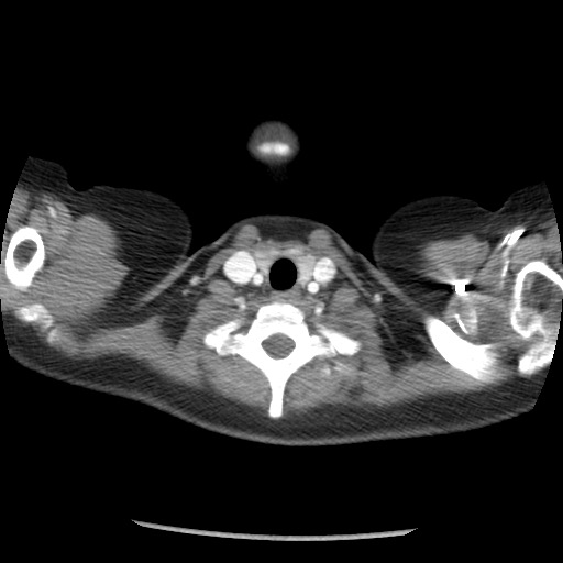 File:Borderline mucinous tumor (ovary) (Radiopaedia 78228-90808 A 2).jpg