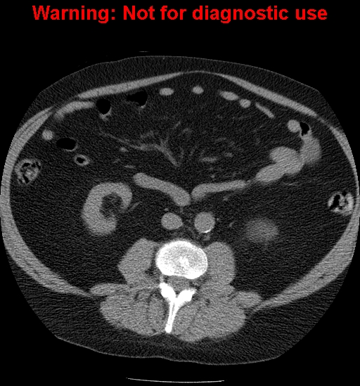 File:Bosniak renal cyst - type IV (Radiopaedia 23402-23466 Axial non-contrast 17).jpg