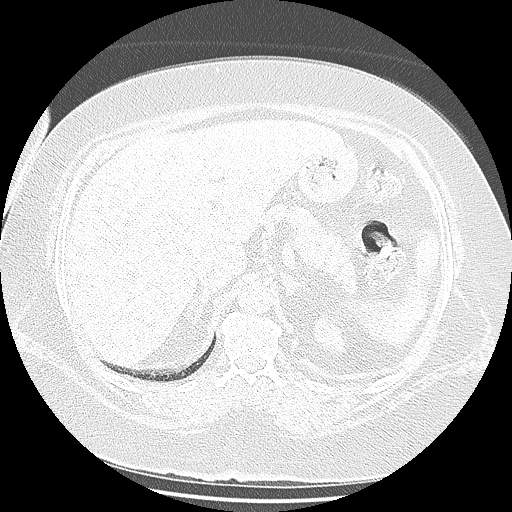 Bovine aortic arch - right internal mammary vein drains into the superior vena cava (Radiopaedia 63296-71875 Axial lung window 179).jpg