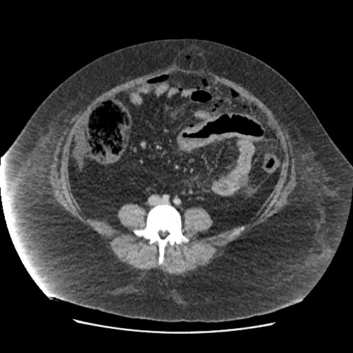 Bowel and splenic infarcts in acute lymphocytic leukemia (Radiopaedia 61055-68915 A 85).jpg