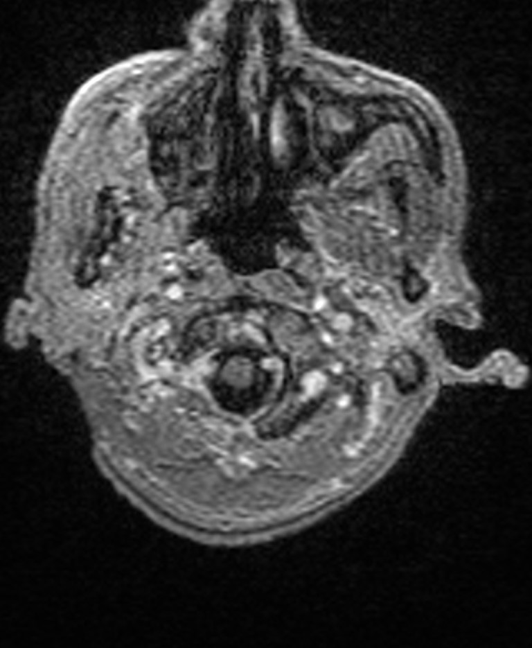 Brain abscess with dual rim sign (Radiopaedia 87566-103938 Axial T1 C+ 16).jpg
