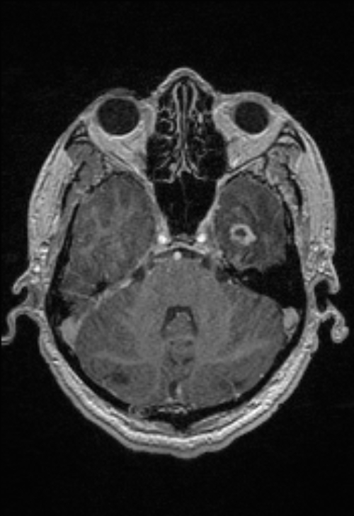 Brain abscess with ventriculitis (Radiopaedia 85703-101495 Axial T1 C+ 54).jpg