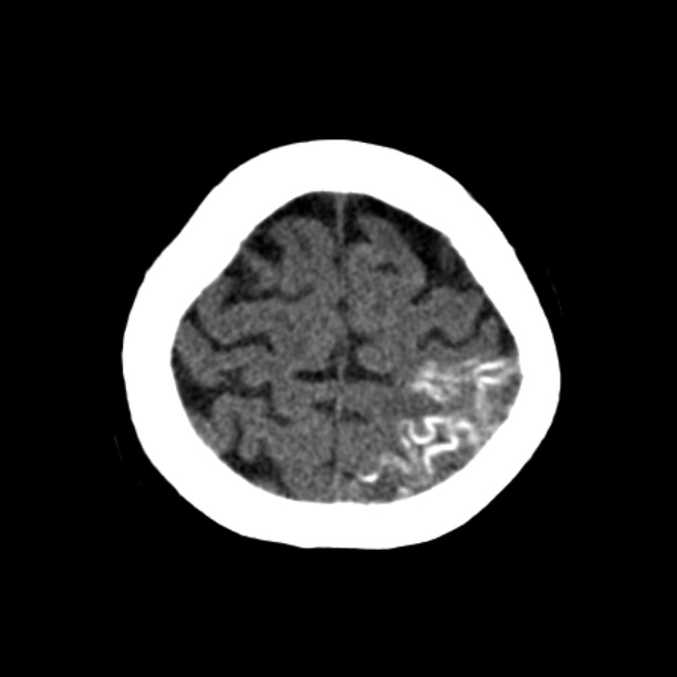 Brain cortical laminar necrosis (Radiopaedia 25822-25971 Axial non-contrast 40).jpg