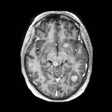 Brain metastases from lung cancer (Radiopaedia 83839-99028 Axial T1 C+ 26).jpg