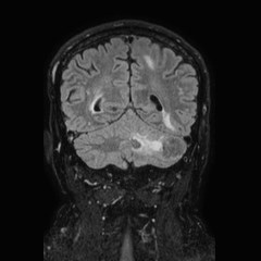 Brain metastases from lung cancer (Radiopaedia 83839-99028 Coronal FLAIR 59).jpg