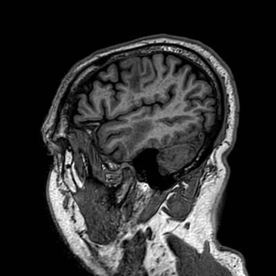 Brain metastases from lung cancer (Radiopaedia 83839-99028 Sagittal T1 108).jpg