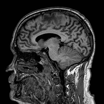 Brain metastases from lung cancer (Radiopaedia 83839-99028 Sagittal T1 72).jpg