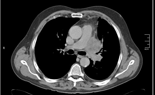 File:Brain metastases from squamocellular lung cancer (Radiopaedia 56515-63219 B 30).jpg