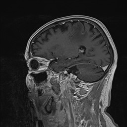 Brain metastasis (Radiopaedia 42617-45761 Sagittal T1 C+ 33).jpg