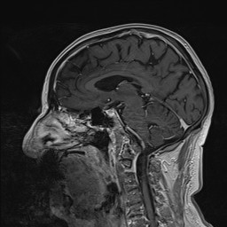 Brain metastasis (Radiopaedia 42617-45761 Sagittal T1 C+ 53).jpg