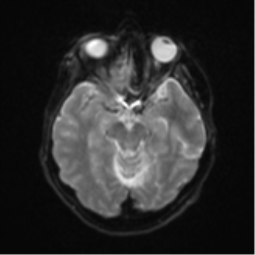 Brain metastasis (sarcoma) (Radiopaedia 47576-52209 Axial DWI 11).png