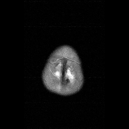 File:Brainstem ganglioglioma (Radiopaedia 10763-11224 Axial T2 1).jpg
