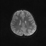 Brainstem glioma (Radiopaedia 67531-76922 Axial DWI 17).jpg