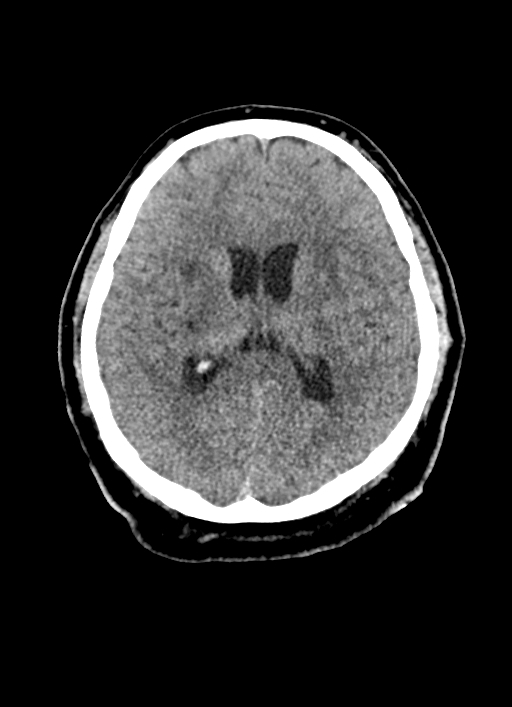 Brainstem hemorrhage (Radiopaedia 81294-94976 Axial non-contrast 29).jpg