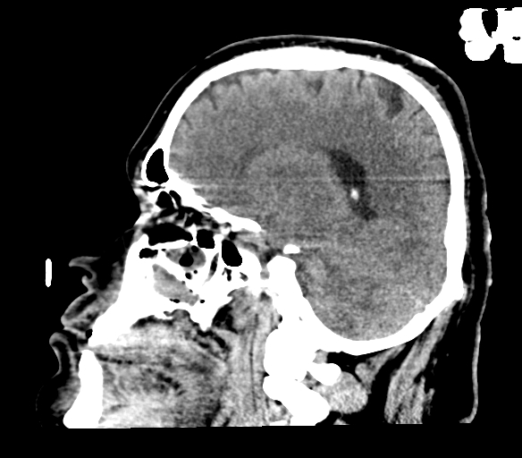 Brainstem hemorrhage (Radiopaedia 81294-94976 C 22).jpg