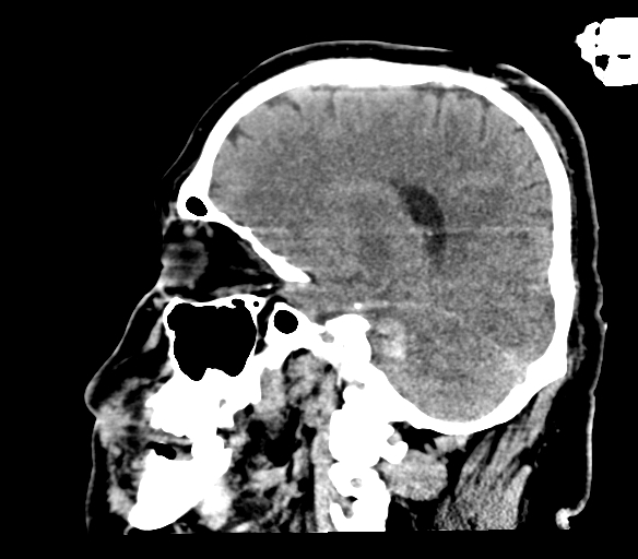 Brainstem hemorrhage (Radiopaedia 81294-94976 C 37).jpg