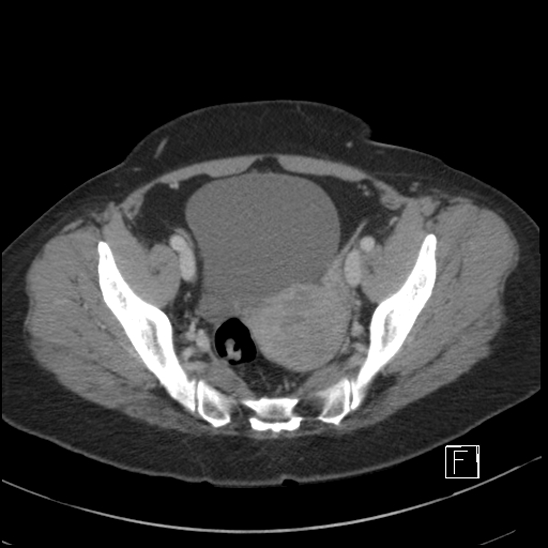 Breast metastases from renal cell cancer (Radiopaedia 79220-92225 C 97).jpg