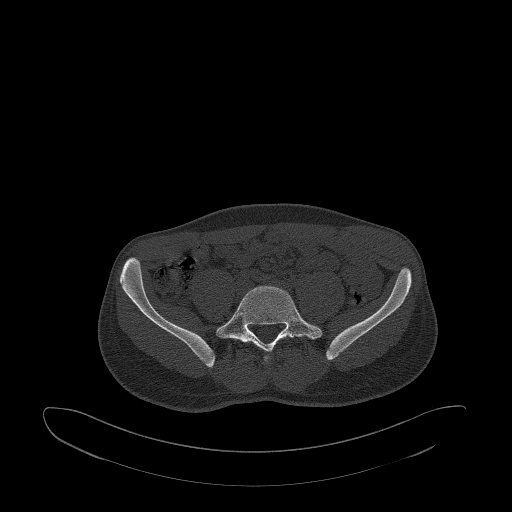 Brodie abscess- femoral neck (Radiopaedia 53862-59966 Axial bone window 2).jpg