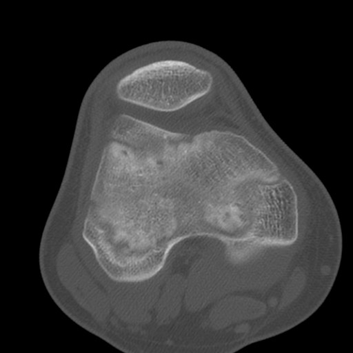 Brodie abscess of the tibia (Radiopaedia 58984-66250 Axial bone window 34).jpg