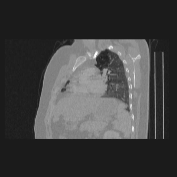 Bronchial atresia (Radiopaedia 60685-68439 Sagittal lung window 59).jpg