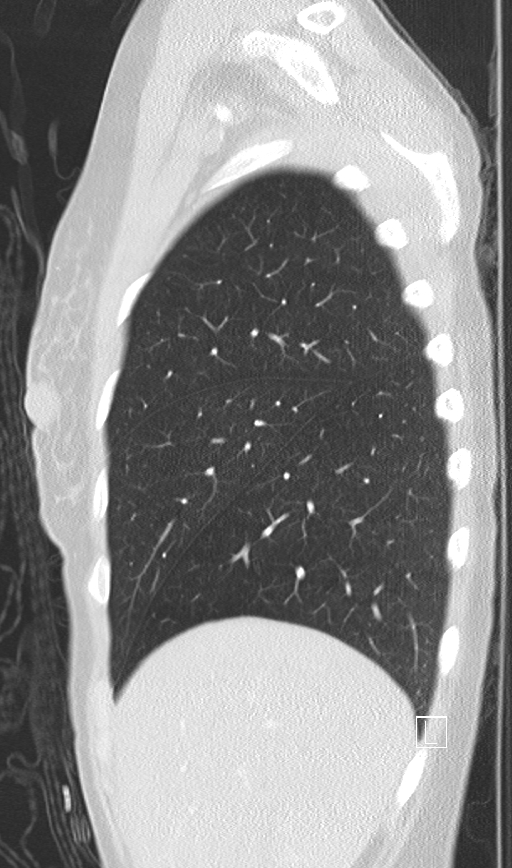 Bronchial atresia (Radiopaedia 73677-84470 Sagittal lung window 10).jpg