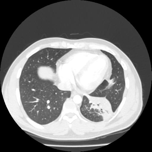 Bronchial carcinoid (Radiopaedia 80013-93291 Axial lung window 91).jpg