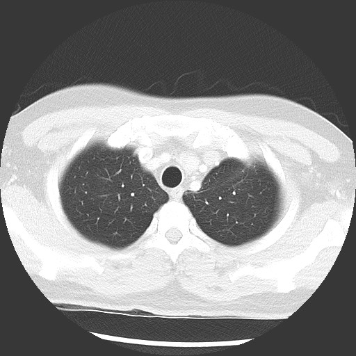 Bronchial carcinoid tumor (Radiopaedia 67377-76764 Axial lung window 14).jpg