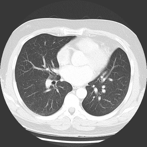 Bronchial carcinoid tumor (Radiopaedia 67377-76764 Axial lung window 36).jpg