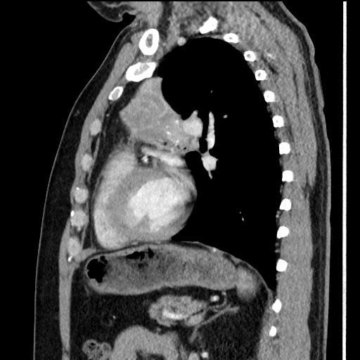File:Bronchial carcinoid tumor (Radiopaedia 67377-76764 E 45).jpg