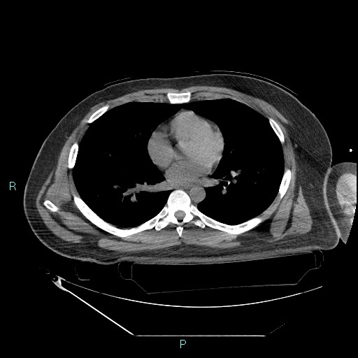 File:Bronchial carcinoid tumor (Radiopaedia 78272-90870 Axial non-contrast 60).jpg