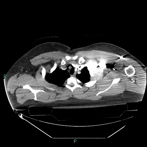 Bronchial carcinoid tumor (Radiopaedia 78272-90870 B 25).jpg