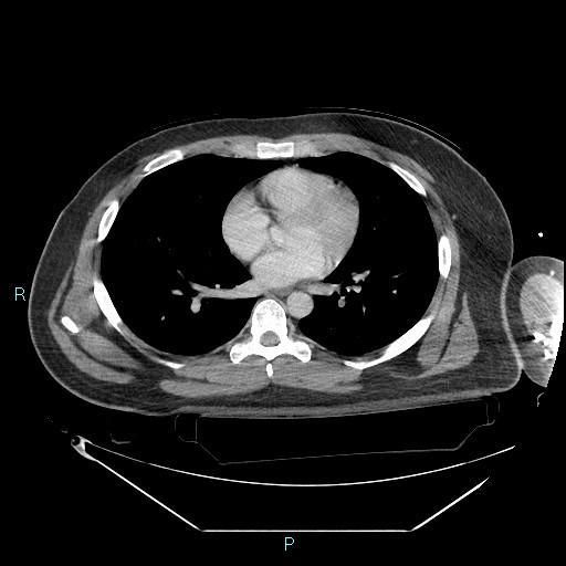 Bronchial carcinoid tumor (Radiopaedia 78272-90870 C 72).jpg