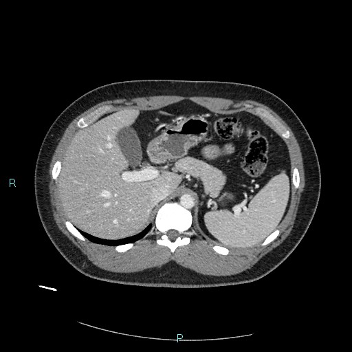 Bronchial carcinoid tumor (Radiopaedia 78272-90875 A 96).jpg