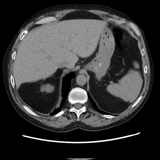 File:Bronchial stenosis - lung transplant (Radiopaedia 73133-83848 Axial non-contrast 55).jpg