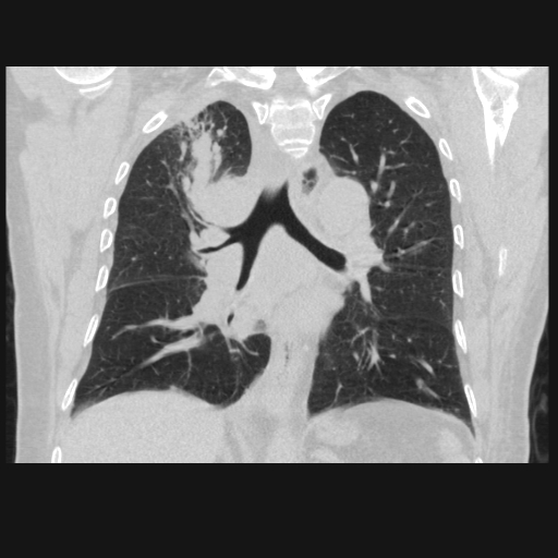 File:Bronchogenic carcinoma with metastatic lymphadenopathy (Radiopaedia 37671-39569 Coronal lung window 28).jpg