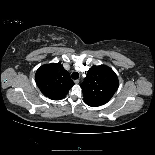 File:Bronchogenic cyst - posterior mediastinal (Radiopaedia 43885-47364 A 12).jpg