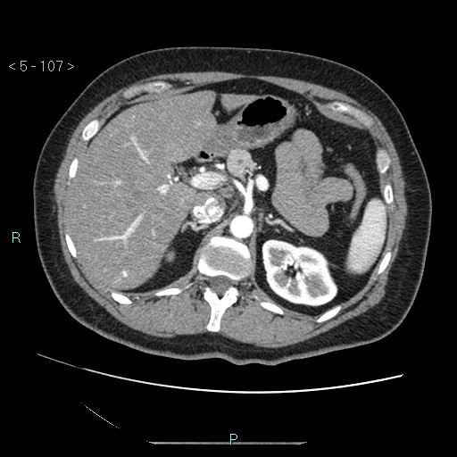 Bronchogenic cyst - posterior mediastinal (Radiopaedia 43885-47364 A 61).jpg