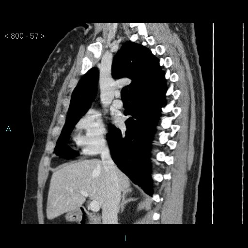 File:Bronchogenic cyst - posterior mediastinal (Radiopaedia 43885-47364 B 38).jpg