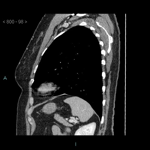 Bronchogenic cyst - posterior mediastinal (Radiopaedia 43885-47364 B 65).jpg