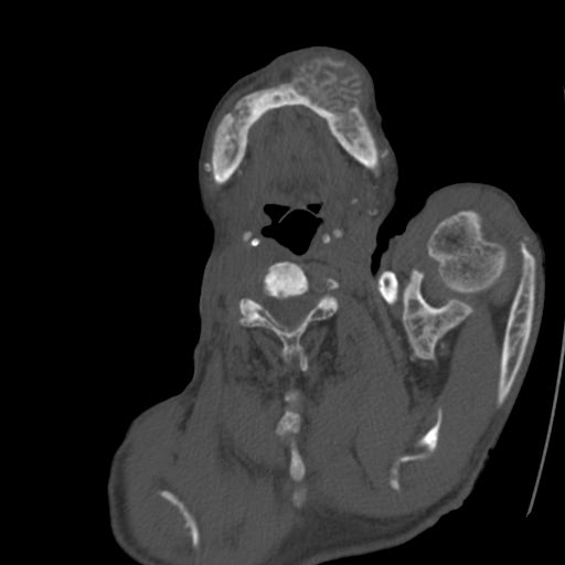 File:Brown tumor with secondary hyperparathyroidism (Radiopaedia 23591-23705 C 6).jpg