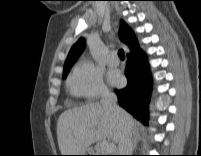 File:Brown tumors compressing the spinal cord (Radiopaedia 68442-77988 B 27).jpg