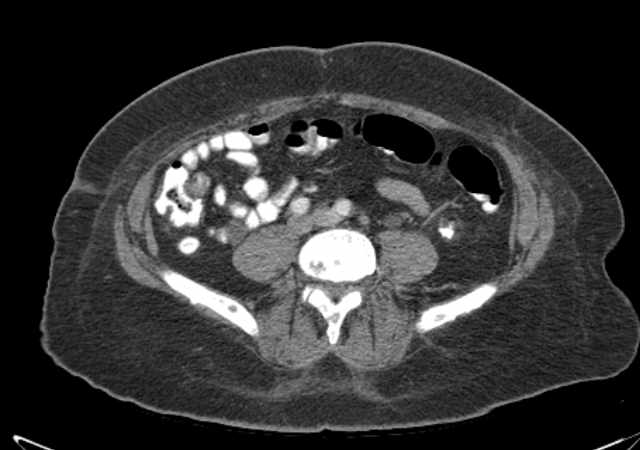 Brown tumors compressing the spinal cord (Radiopaedia 68442-77988 E 79).jpg