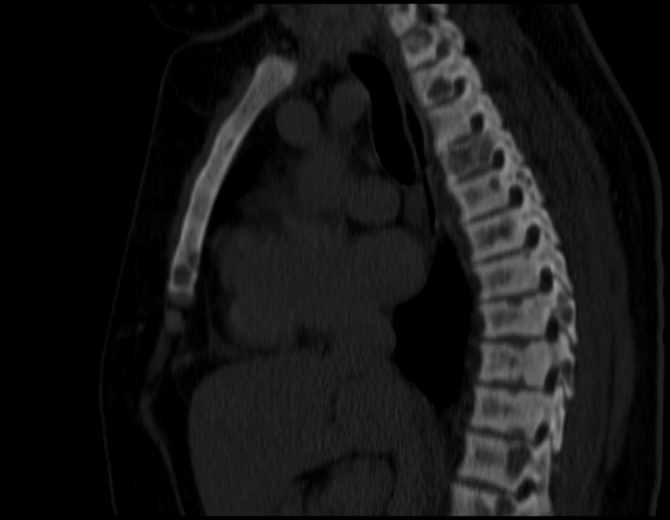 Brown tumors compressing the spinal cord (Radiopaedia 68442-77988 Sagittal bone window 28).jpg
