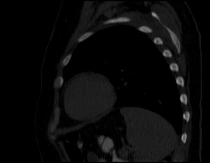 Brown tumors compressing the spinal cord (Radiopaedia 68442-77988 Sagittal bone window 45).jpg
