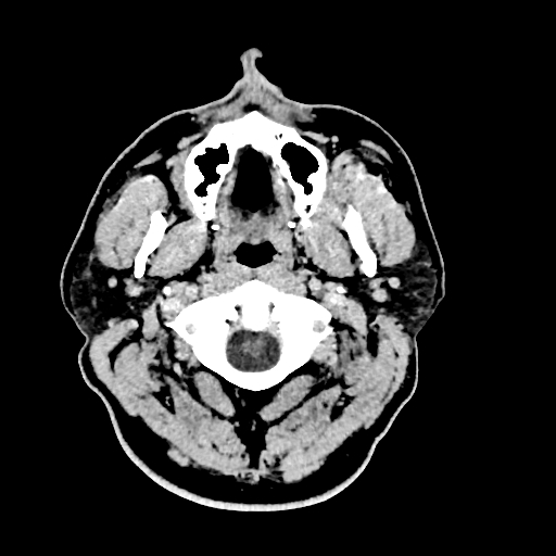 Buccal fat pad arteriovenous malformation (Radiopaedia 70936-81142 Axial non-contrast 28).jpg